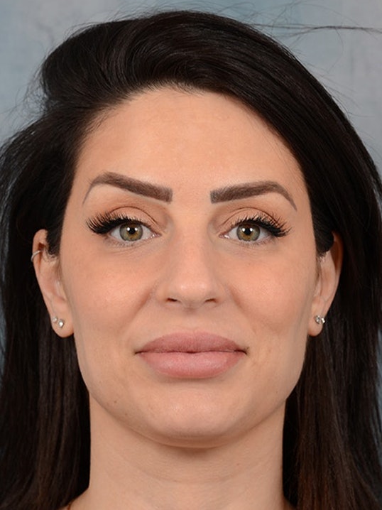 Rhinoplasty Gallery - Patient 9901040 - Image 1