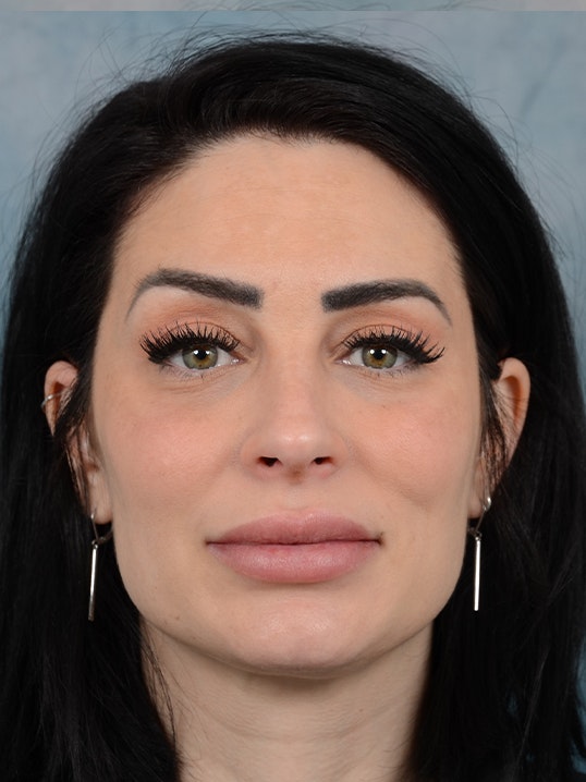 Rhinoplasty Gallery - Patient 9901040 - Image 2