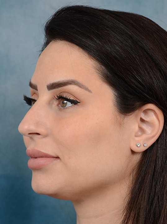 Rhinoplasty Gallery - Patient 9901040 - Image 3