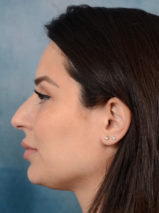Rhinoplasty Gallery - Patient 9901040 - Image 5