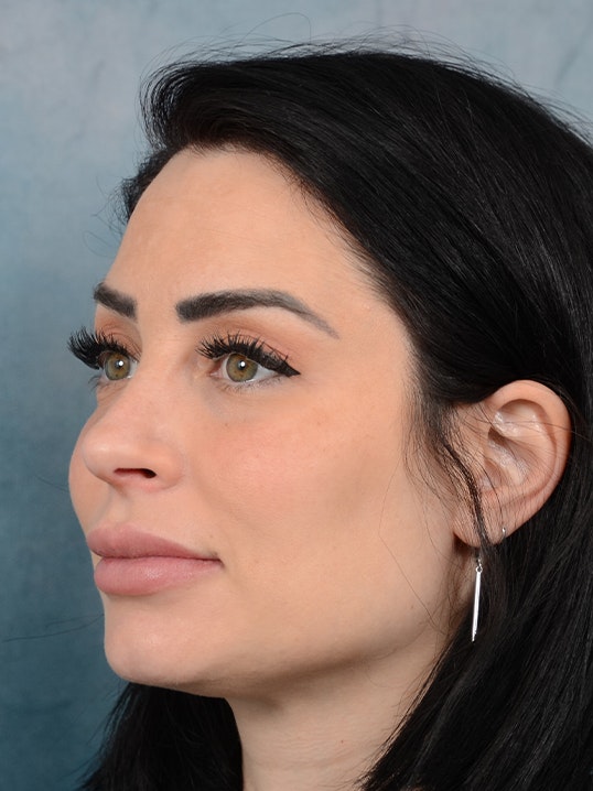 Rhinoplasty Gallery - Patient 9901040 - Image 4