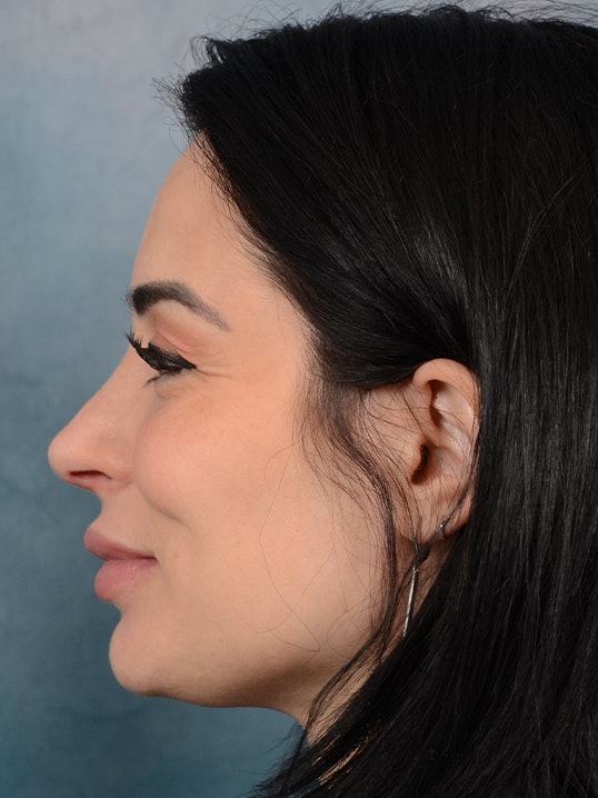 Rhinoplasty Gallery - Patient 9901040 - Image 6