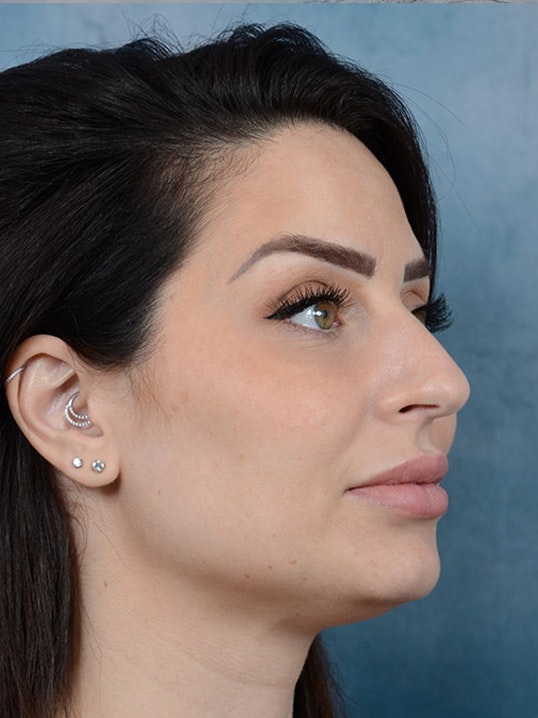 Rhinoplasty Gallery - Patient 9901040 - Image 7