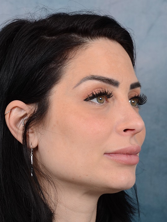 Rhinoplasty Gallery - Patient 9901040 - Image 8