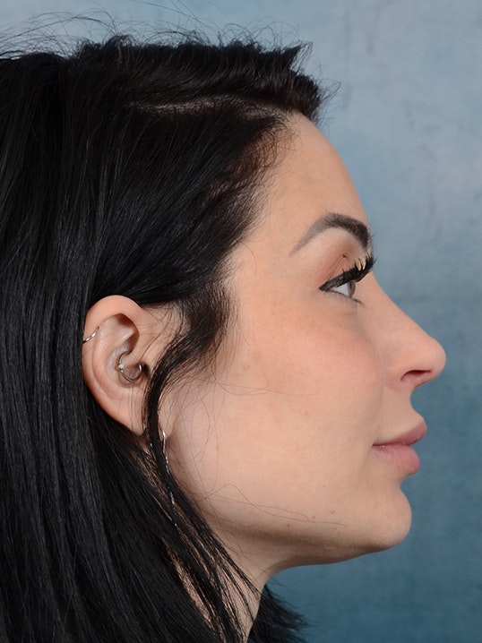 Rhinoplasty Gallery - Patient 9901040 - Image 10