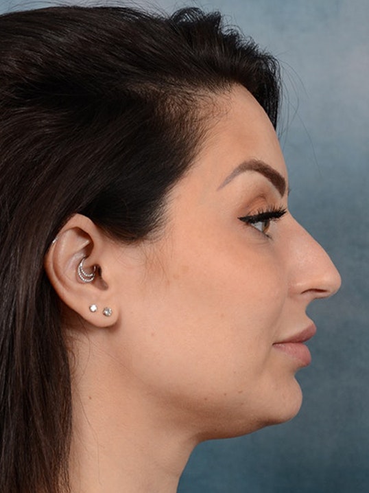 Rhinoplasty Gallery - Patient 9901040 - Image 9