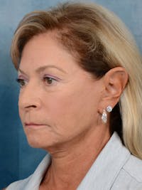 Deep Plane Facelift Before & After Gallery - Patient 15930433 - Image 1