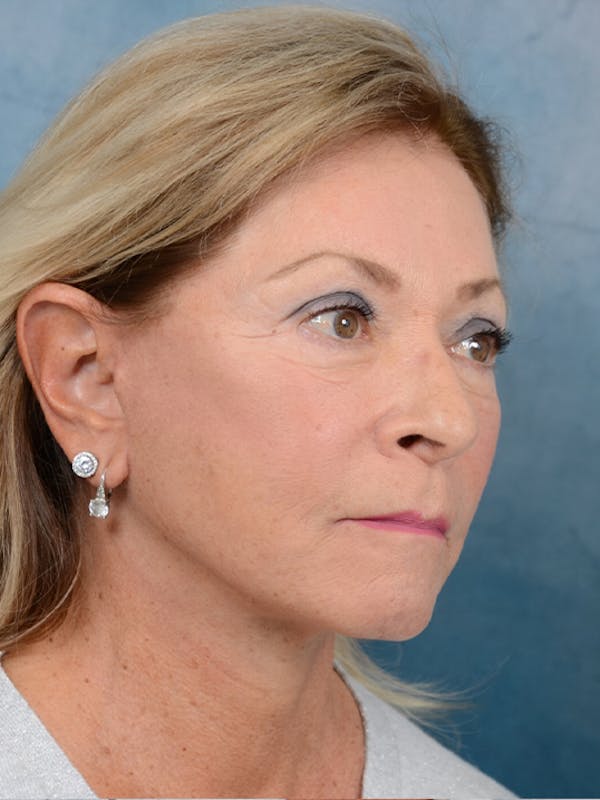 Deep Plane Facelift Before & After Gallery - Patient 15930433 - Image 8