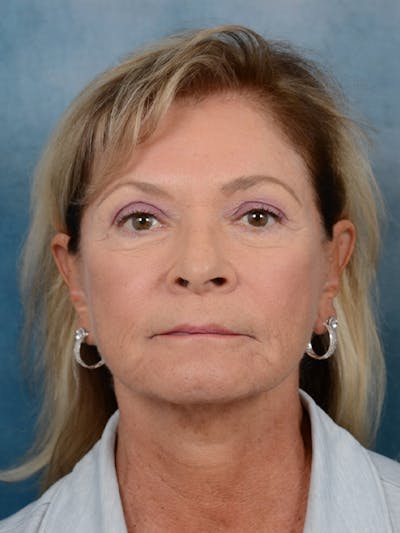 Brow Lift Before & After Gallery - Patient 15930450 - Image 1