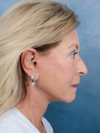 Brow Lift Before & After Gallery - Patient 15930450 - Image 10