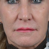 Lip Lift Before & After Gallery - Patient 16861941 - Image 1