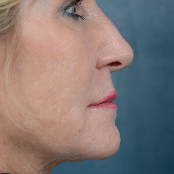 Lip Lift Before & After Gallery - Patient 16861941 - Image 5