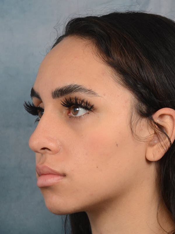 Rhinoplasty Before & After Gallery - Patient 16862101 - Image 5
