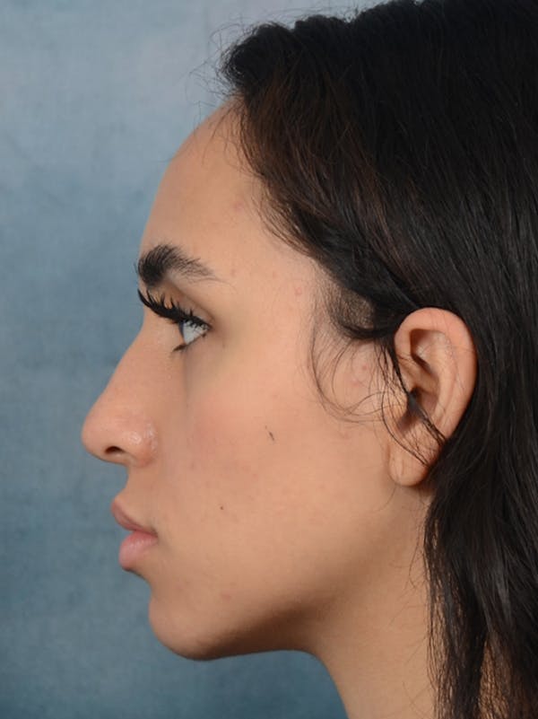 Rhinoplasty Before & After Gallery - Patient 16862101 - Image 1