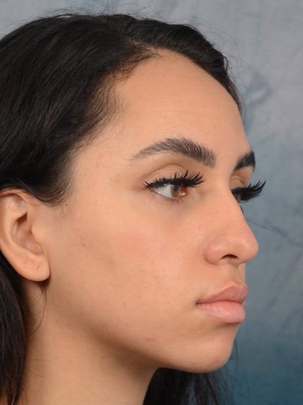 Rhinoplasty Before & After Gallery - Patient 16862101 - Image 7