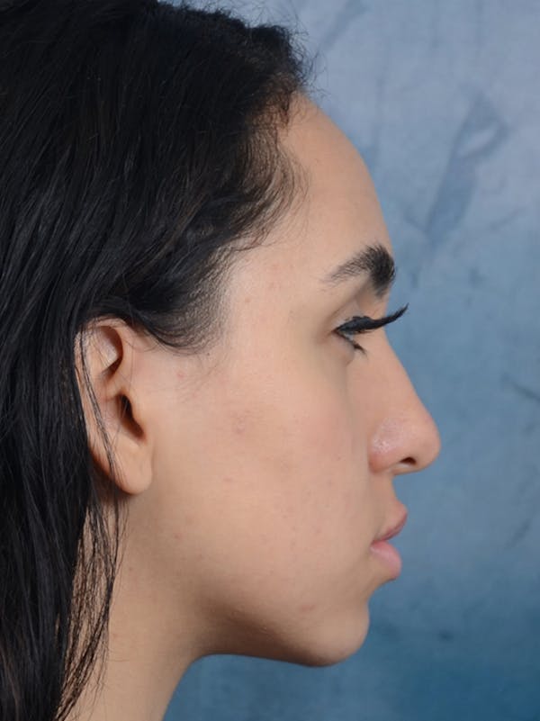 Rhinoplasty Before & After Gallery - Patient 16862101 - Image 9