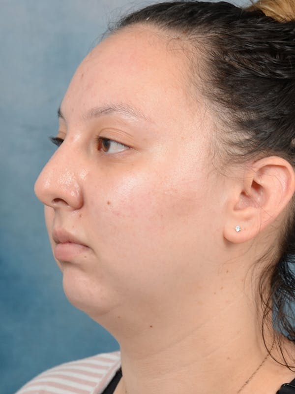 Chin Augmentation Before & After Gallery - Patient 18728002 - Image 3