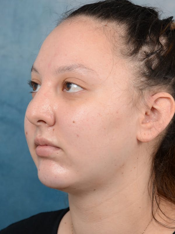 Chin Augmentation Before & After Gallery - Patient 18728002 - Image 4