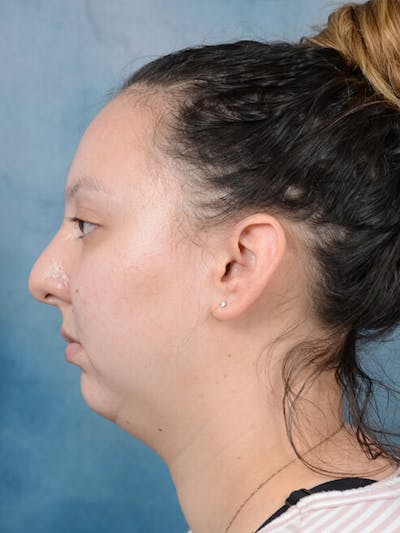 Chin Augmentation Before