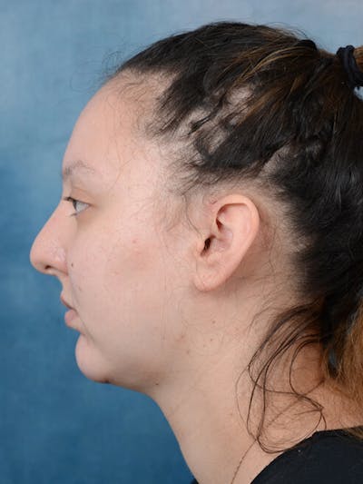 Chin Augmentation After