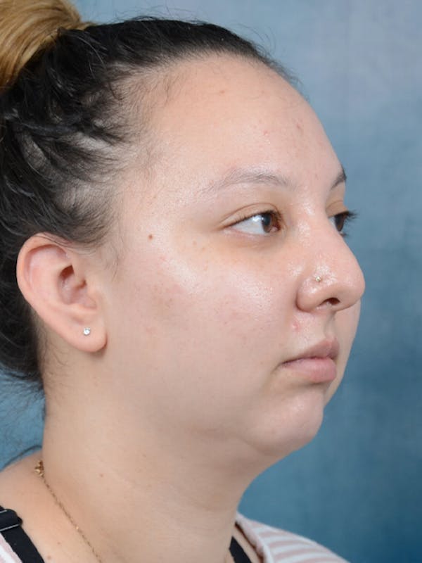 Chin Augmentation Before & After Gallery - Patient 18728002 - Image 7