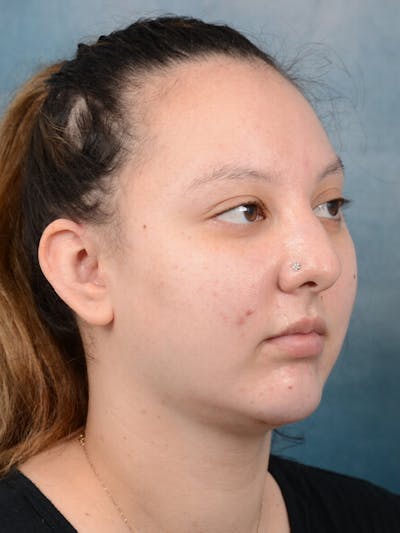 Chin Augmentation Before & After Gallery - Patient 18728002 - Image 8