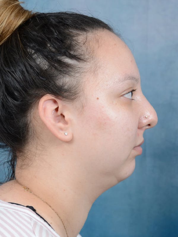 Neck Liposuction Before & After Gallery - Patient 18728009 - Image 9