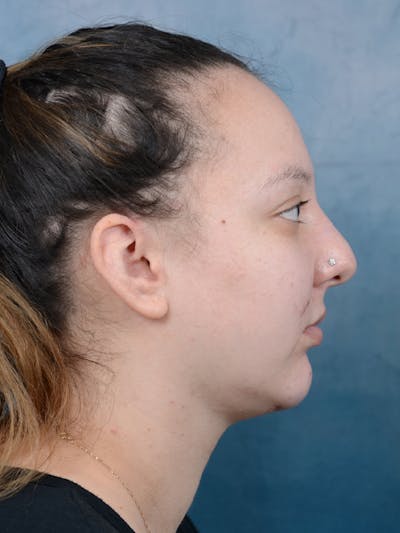 Chin Augmentation Before & After Gallery - Patient 18728002 - Image 10