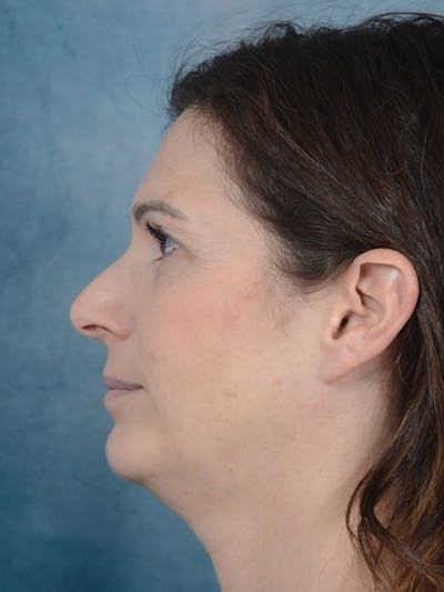 Chin Augmentation Before