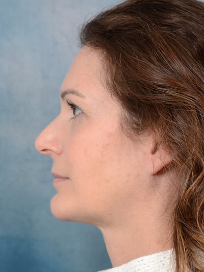 Chin Augmentation After