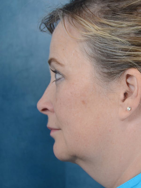 Laser Skin Resurfacing Before & After Gallery - Patient 18908953 - Image 5