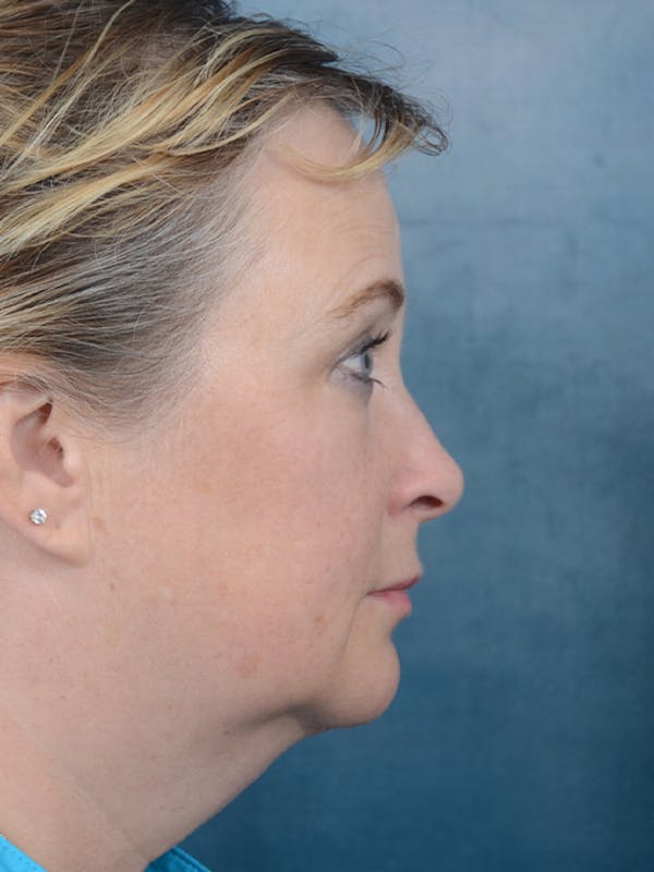 Laser Skin Resurfacing Before & After Gallery - Patient 18908953 - Image 9