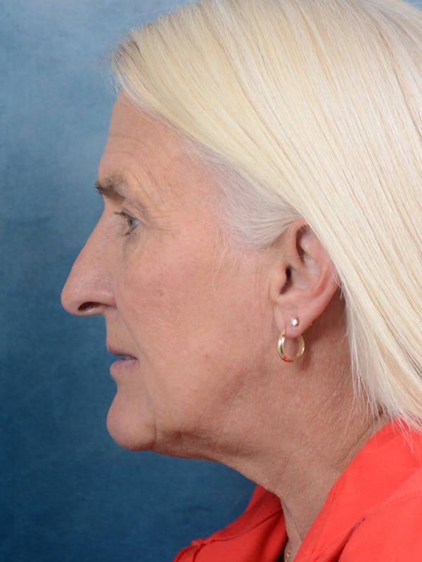 Deep Plane Facelift Before & After Gallery - Patient 19056123 - Image 5