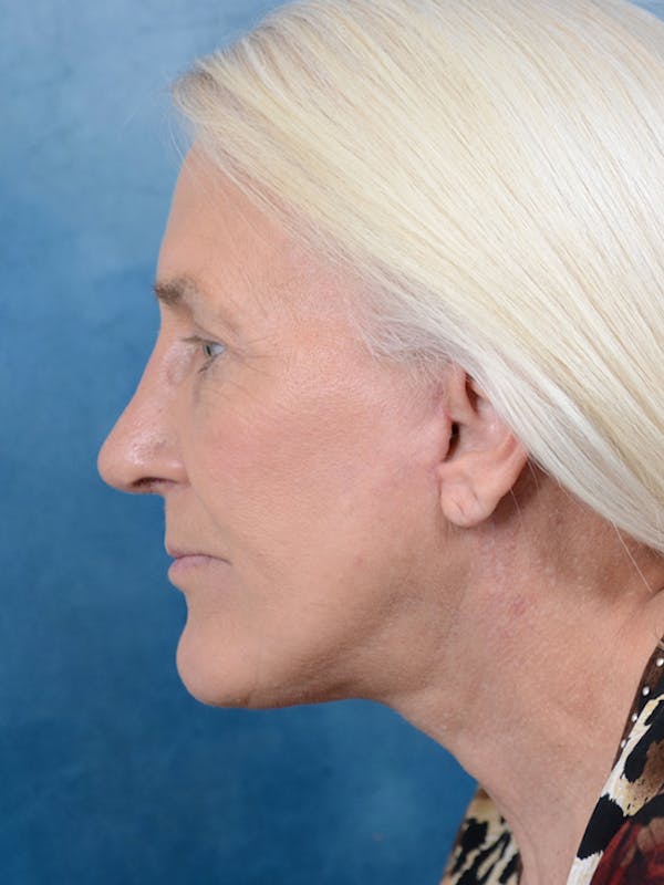 Rhinoplasty Before & After Gallery - Patient 19056131 - Image 2