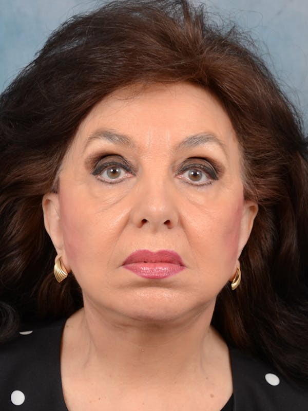 Deep Plane Facelift Before & After Gallery - Patient 20542929 - Image 4