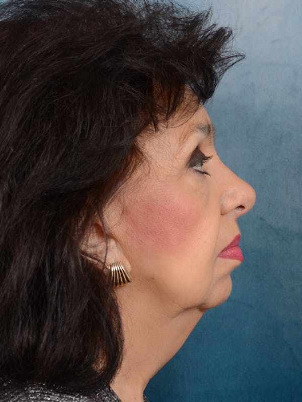 Deep Plane Facelift Before & After Gallery - Patient 20542929 - Image 5