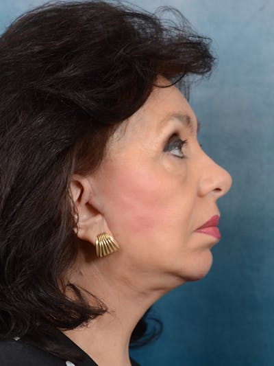 Chin Augmentation Before & After Gallery - Patient 20542952 - Image 6