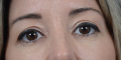 Eyelid Lift Gallery - Patient 24079262 - Image 1