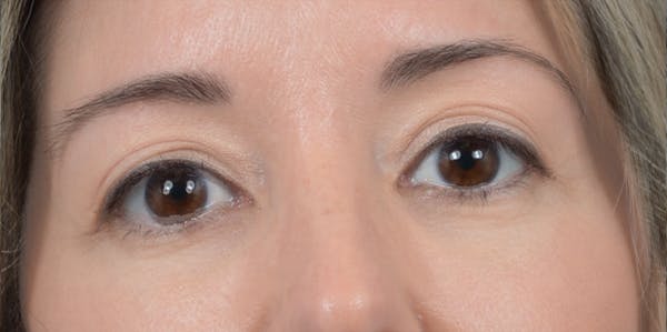 Eyelid Lift Gallery - Patient 24079262 - Image 2