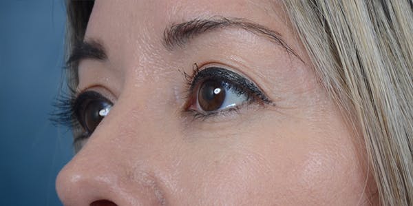 Eyelid Lift Before & After Gallery - Patient 24079262 - Image 3
