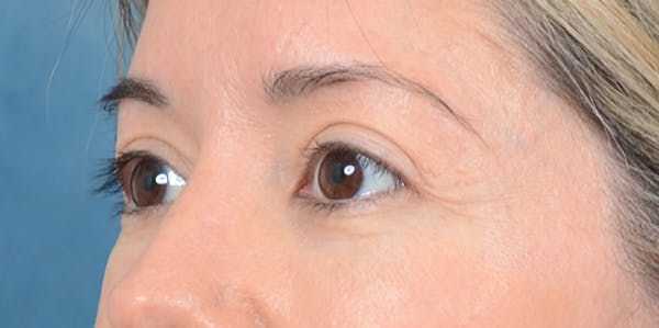 Eyelid Lift Before & After Gallery - Patient 24079262 - Image 4