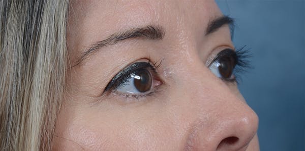 Eyelid Lift Before & After Gallery - Patient 24079262 - Image 5