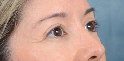 Eyelid Lift Before & After Gallery - Patient 24079262 - Image 6