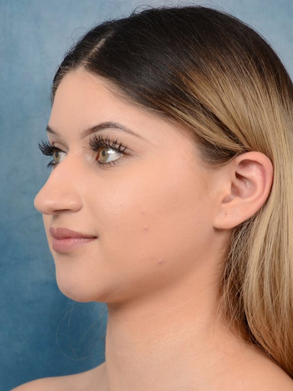 Rhinoplasty Before & After Gallery - Patient 24814014 - Image 5