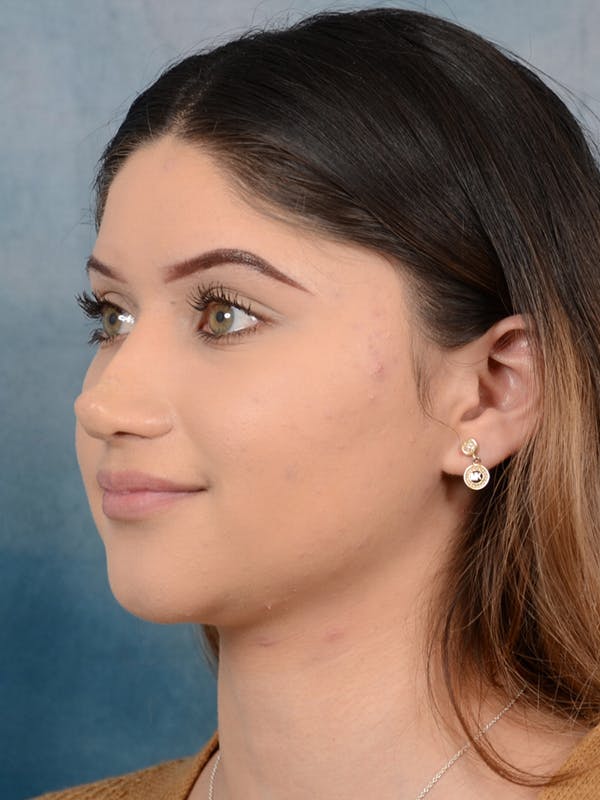 Rhinoplasty Before & After Gallery - Patient 24814014 - Image 6