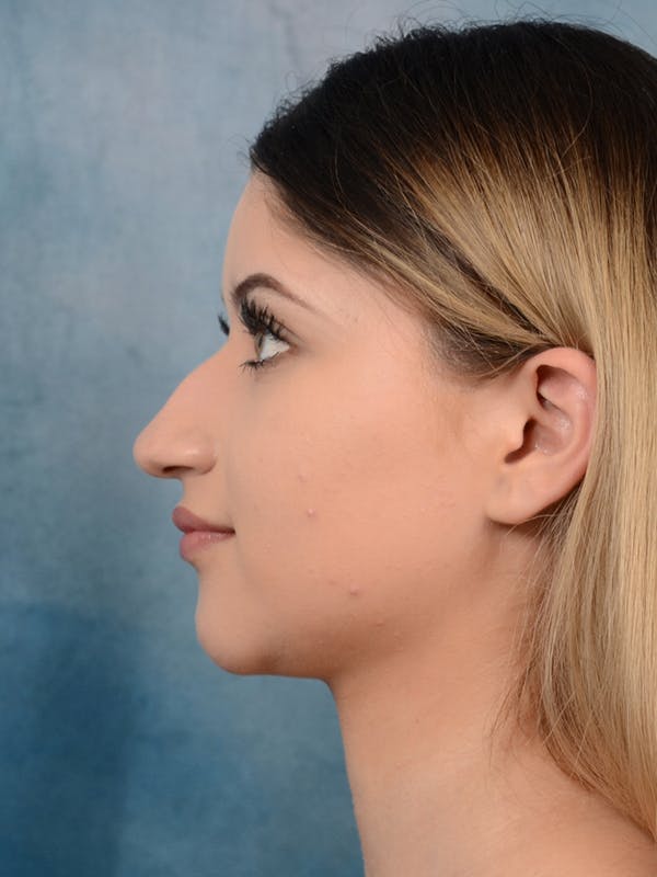 Rhinoplasty Before & After Gallery - Patient 24814014 - Image 1