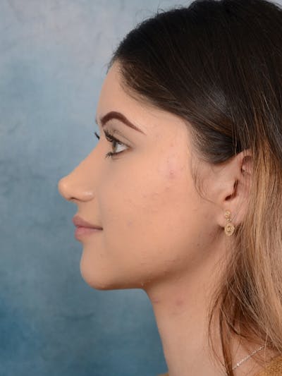 Rhinoplasty Before & After Gallery - Patient 24814014 - Image 2