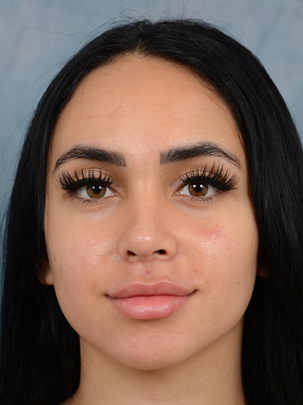 Rhinoplasty Before & After Gallery - Patient 16862101 - Image 4