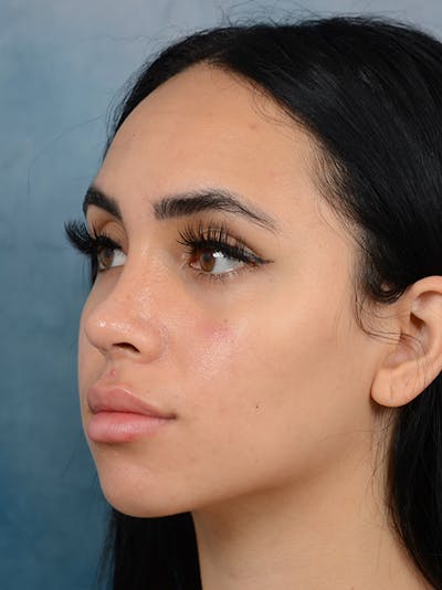 Rhinoplasty Before & After Gallery - Patient 16862101 - Image 6