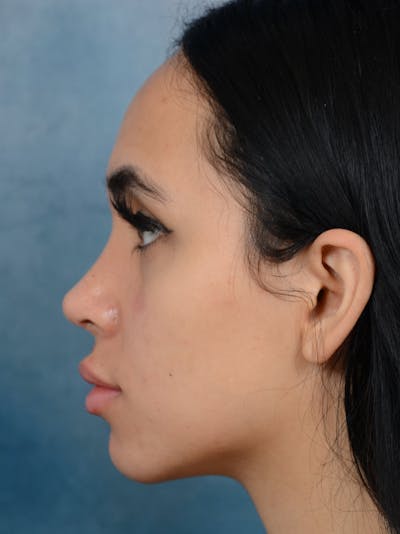 Rhinoplasty Before & After Gallery - Patient 16862101 - Image 2